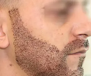 Greffe de barbe